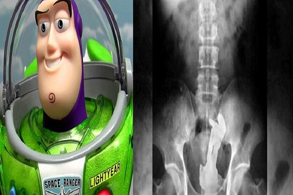 Acude a emergencias a que le saquen un muñeco ‘Buzz Lightyear’ del recto