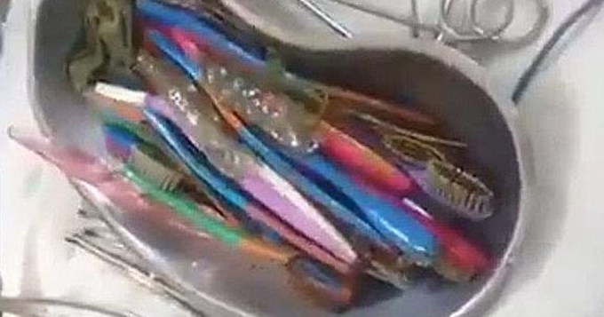 Le sacan del estómago 18 cepillos de dientes y un sacacorchos