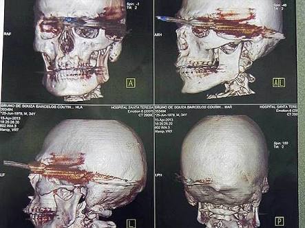 Se incrusta un arpón en la cara y sobrevive de milagro