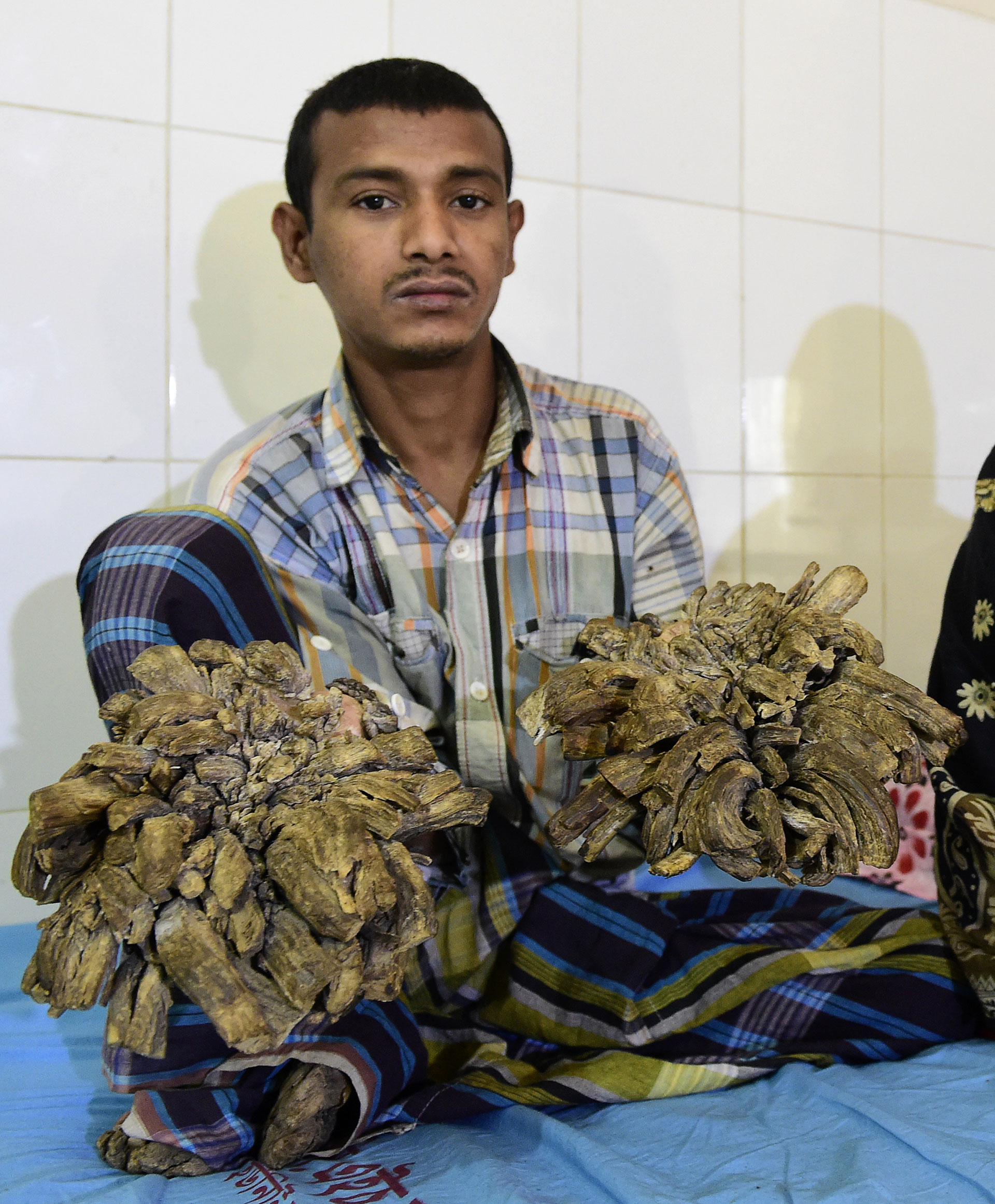 Operan al ‘hombre árbol’ de Bangladesh