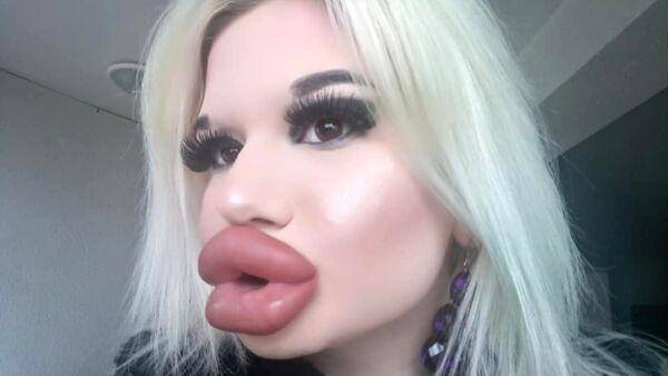 ¡Bembona! Tras 20 rellenos, a los 22 años tiene los labios más grandes del mundo