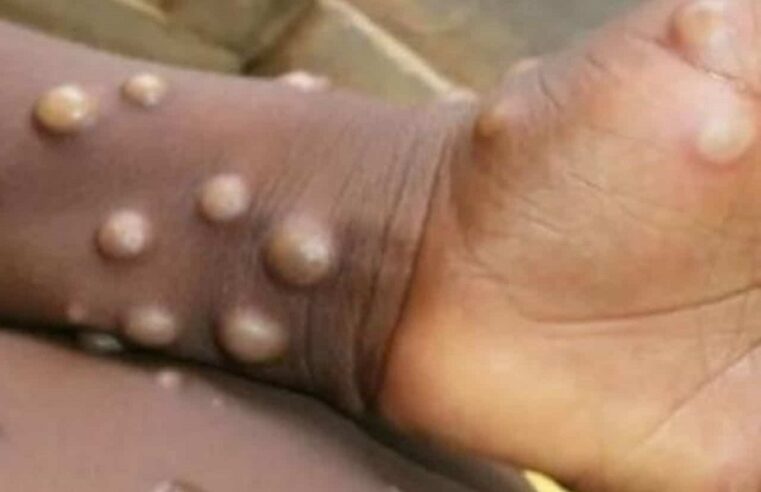Confirman dos casos de viruela símica en Yucatán