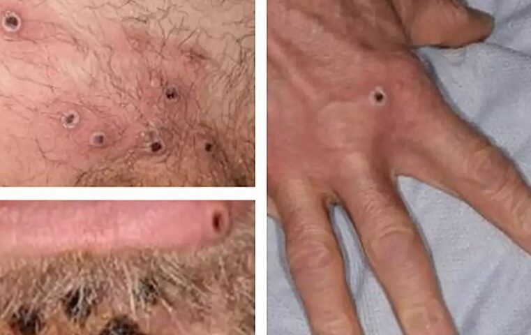 Se registran 7 nuevos casos de viruela del mono en Yucatán