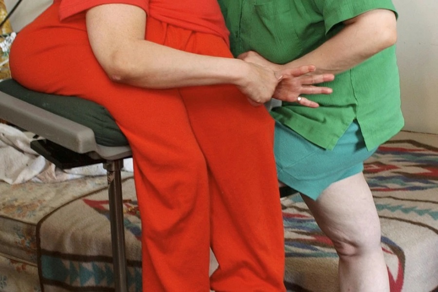 Lori y George Schappell, los siameses más longevos, mueren a los 62 años