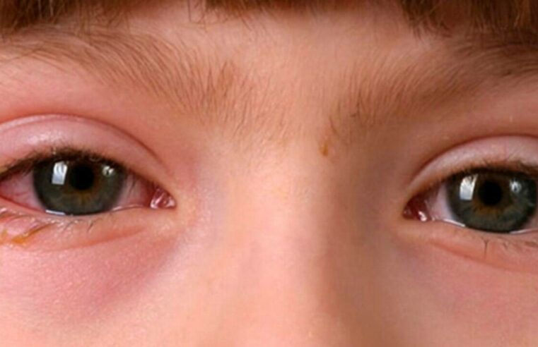 ¡Aguas! Causas y síntomas de la conjuntivitis en niños