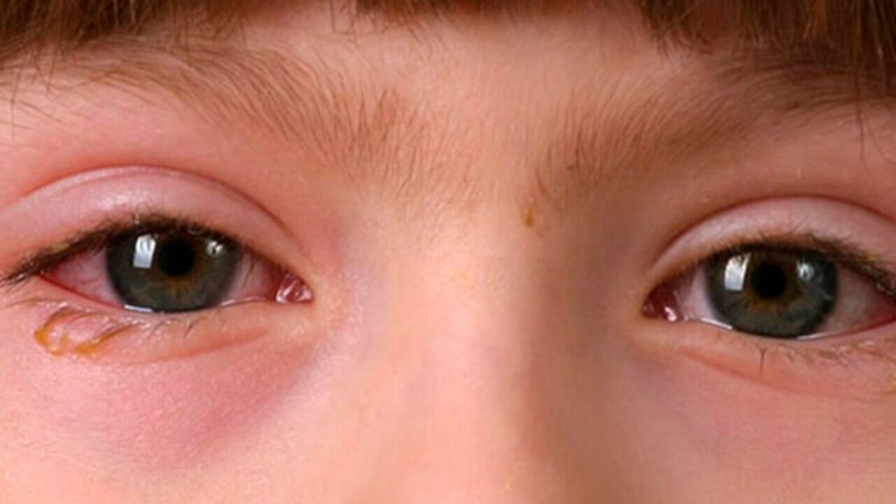 ¡Aguas! Causas y síntomas de la conjuntivitis en niños