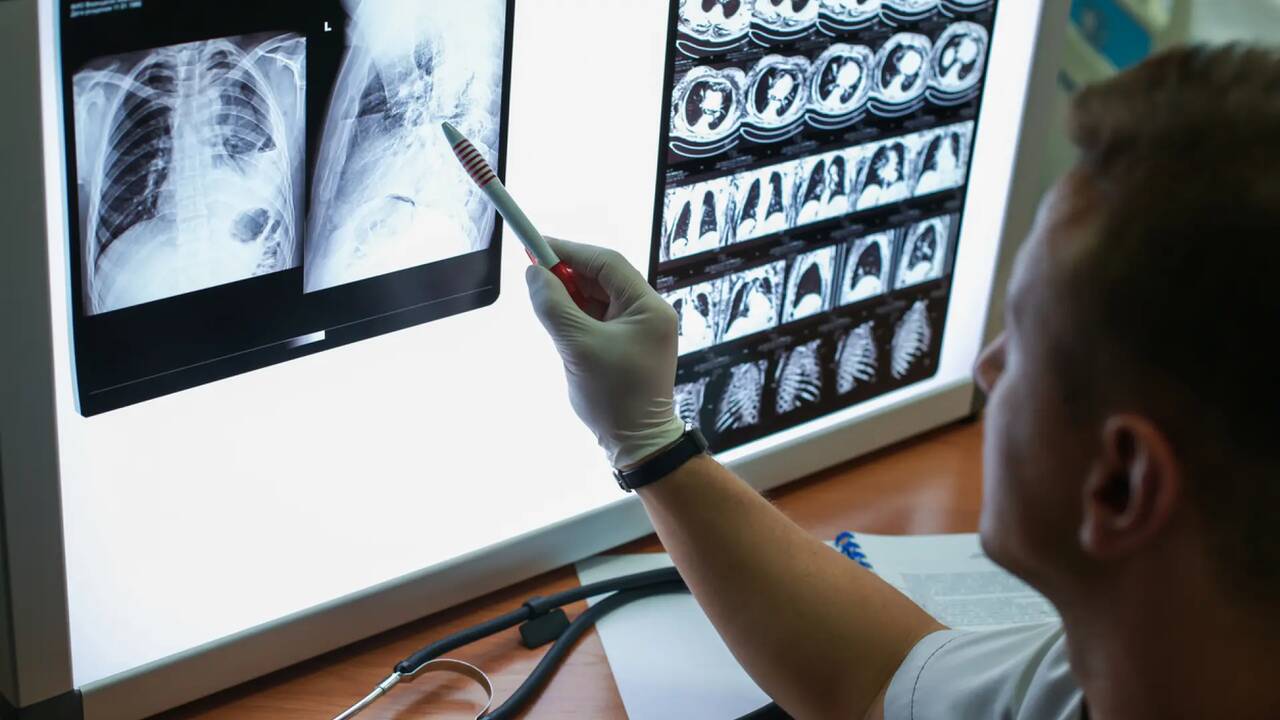 Los cinco tipos de cáncer que fueron más letales en el 2024