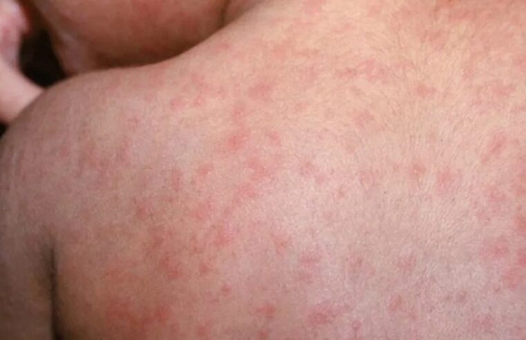 Brote de sarampión en Texas: muere un niño no vacunado