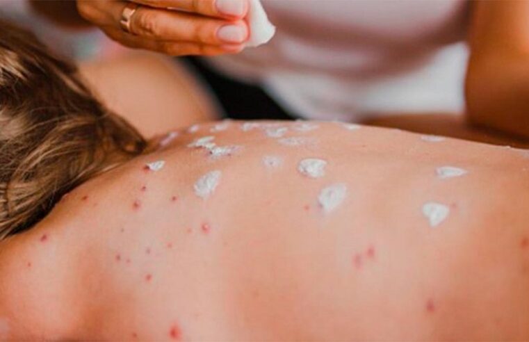 Texas reporta segunda muerte por sarampión; la paciente no estaba vacunada