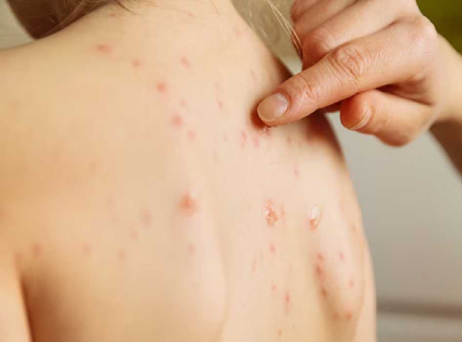 Detectan un caso de sarampión en Bacalar: es el primero en Quintana Roo