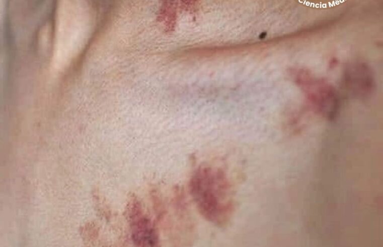 Los chupetones te pueden matar