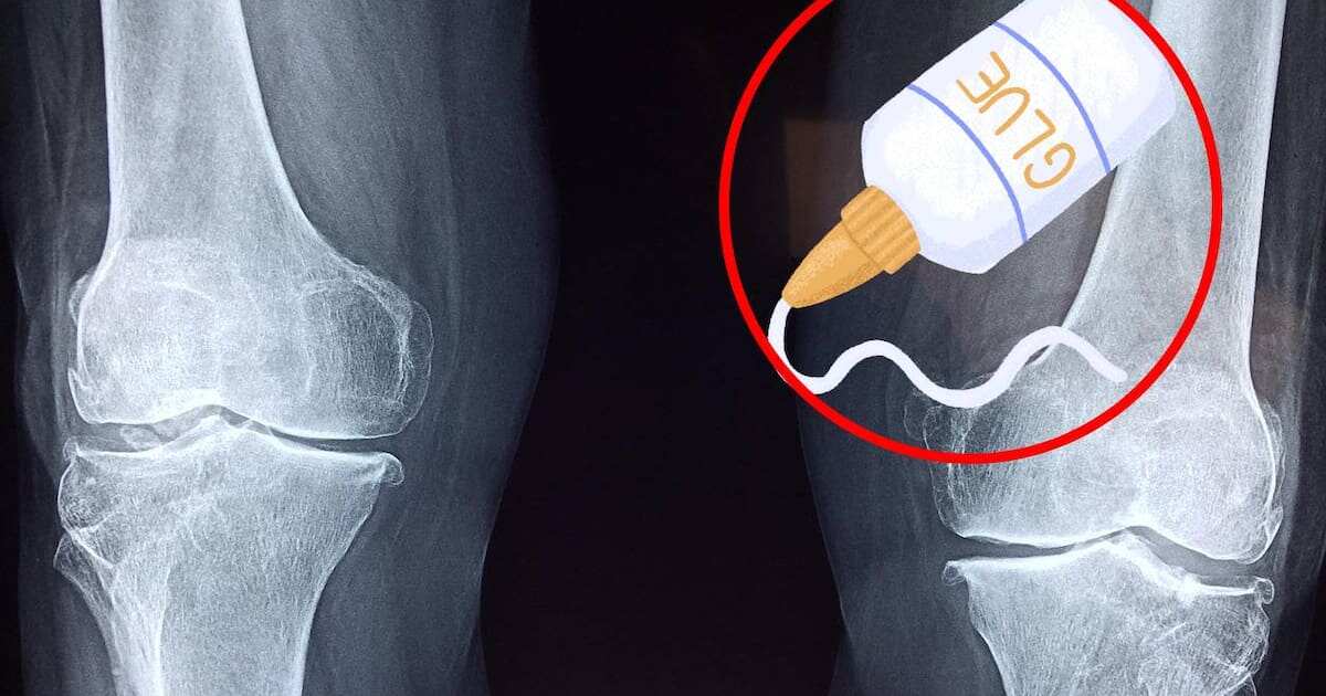 Científicos chinos crean un pegamento óseo para reparar fracturas en minutos