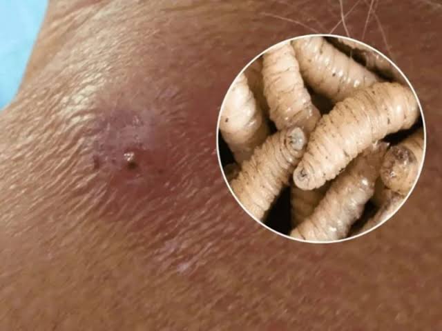 Confirman segundo caso de gusano barrenador en humanos en Yucatán