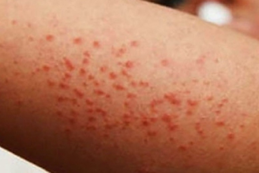 El sarampión se expande por todo México: piden vacunarse