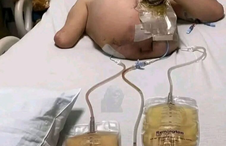 La máquina lo aplastó, los doctores lo cortaron en dos… jy sigue vivo!