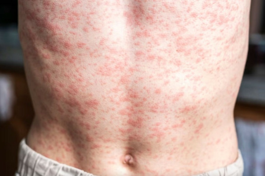 Muere niño por complicaciones de sarampión en Tlaxcala