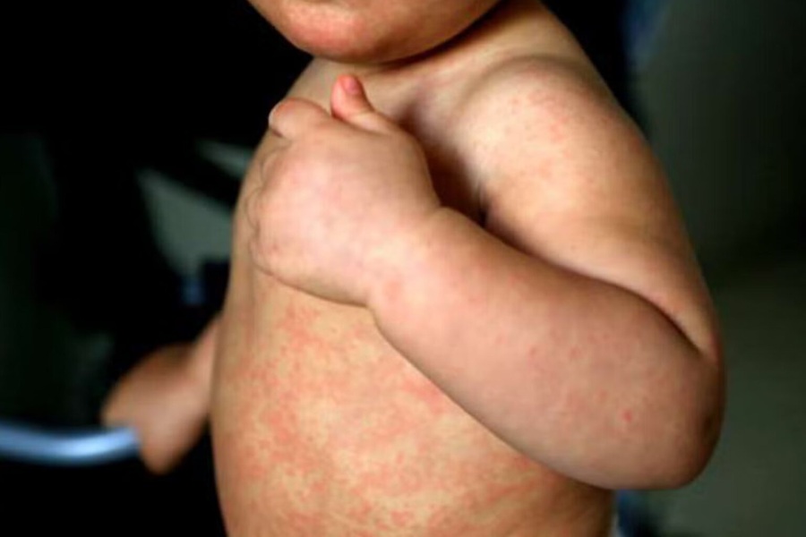 México rebasa los 10 mil casos de sarampión