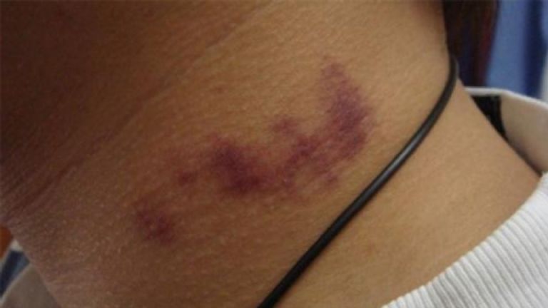 Adolescente muere tras recibir un «chupetón» en el cuello